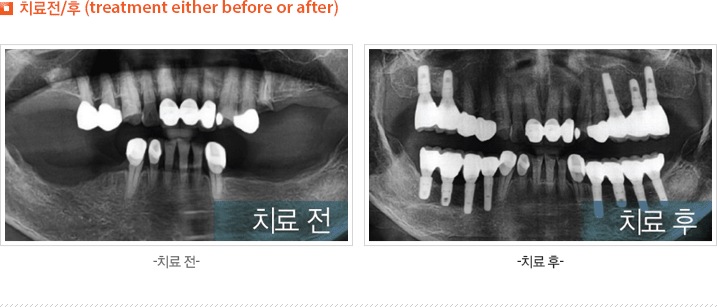치료전/후 (treatment either before or after)